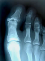 x-ray of fracture